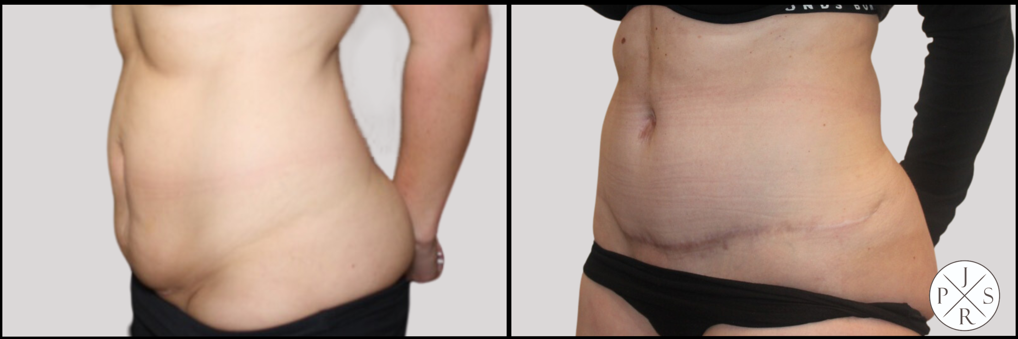 Abdominoplasty Before & After Image